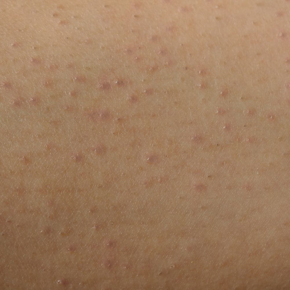 KeratosisPilaris-4