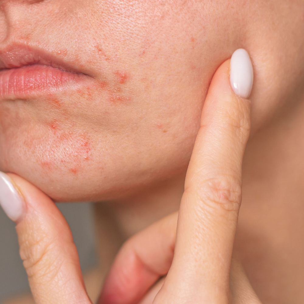 Hva er perioral dermatitt og hvordan behandle det?